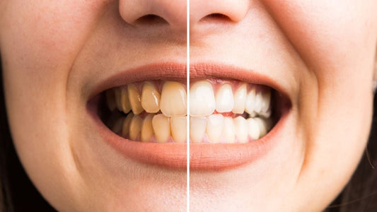 How White Is TOO White? - Smile360 Teeth Whitening