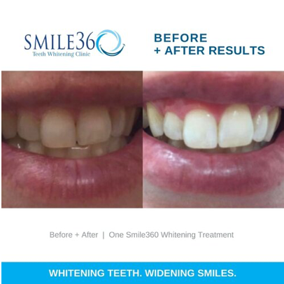 Smile360 Teeth Whitening Canada Before and After Photos