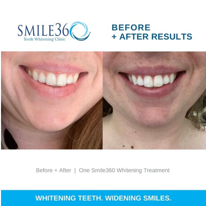 Smile360 Teeth Whitening Canada Before and After Photos