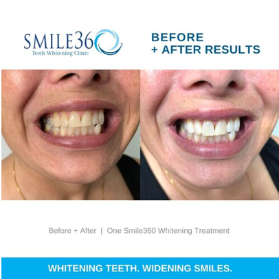 Smile360 Teeth Whitening Canada Before and After Photos